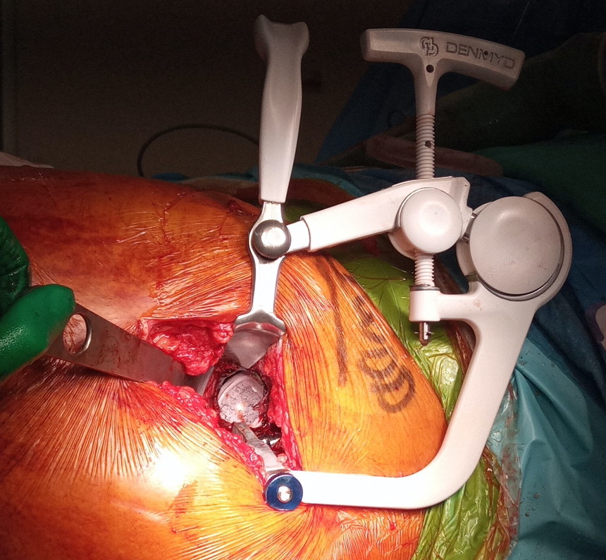 Hip Tissue Retractor - Image 1